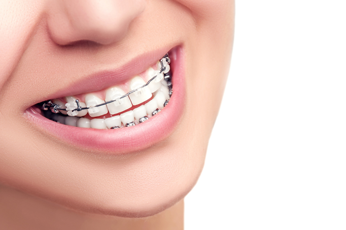 15 Maddede Diş Teli Tedavisi