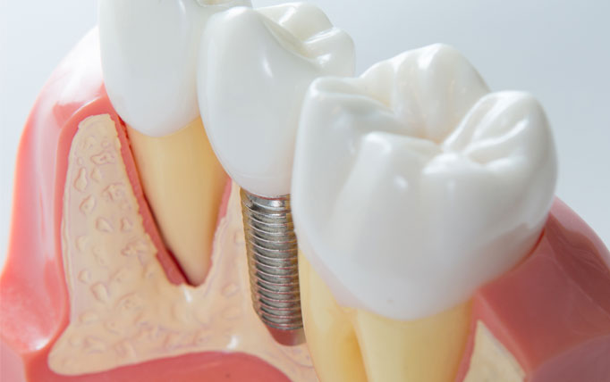 Endodonti ve Kanal Tedavisi Nasıl Yapılır