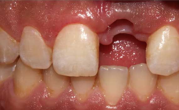 implant-ustu-emax-dis-oncesi implant-ustu-emax-dis-oncesi