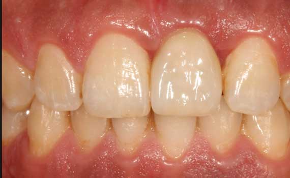 implant-ustu-emax-dis-sonrasi implant-ustu-emax-dis-sonrasi