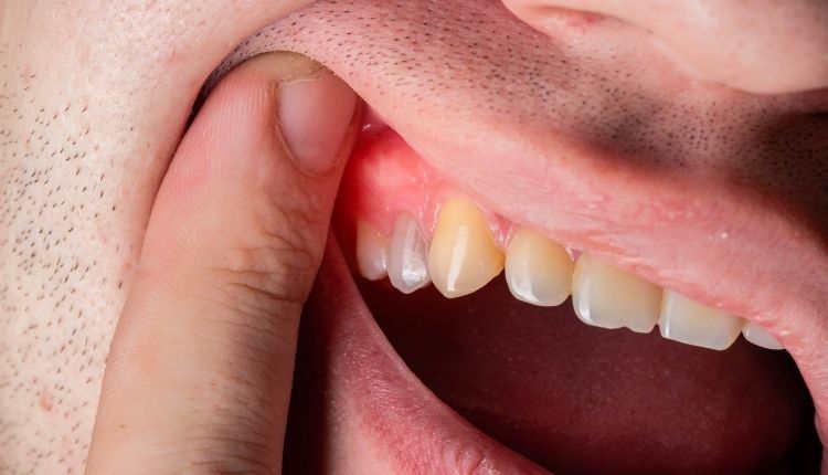 Diş Eti Kanseri Nedir Belirtileri Nelerdir